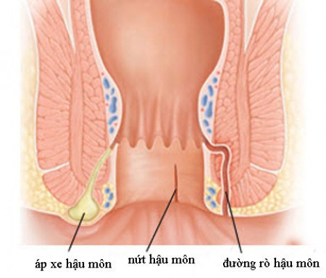 Rò hậu môn - Tổng quan và phương pháp điều trị